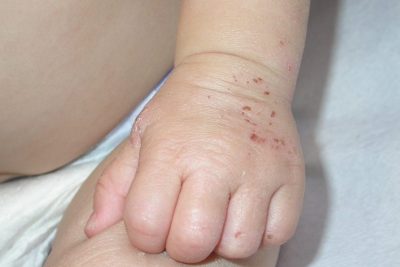 dermatitis atopica